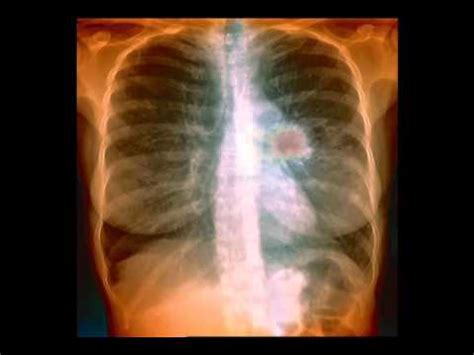 Is damage to lungs reversible?