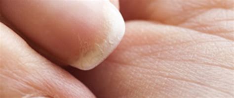 Is dehydration bad for your nails?