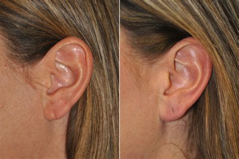 Is earlobe repair painful?