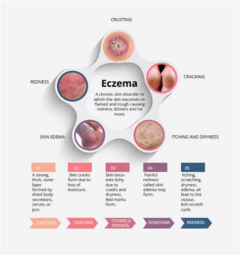 Is eczema a 7 year cycle?