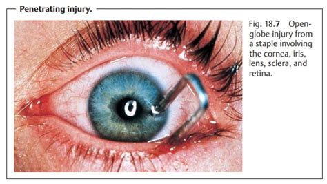 Is eye trauma serious?