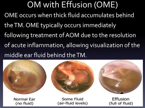 Is fluid behind eardrum serious?
