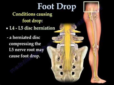 Is foot drop nerve L4 or L5?