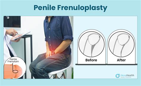 Is frenuloplasty easy?