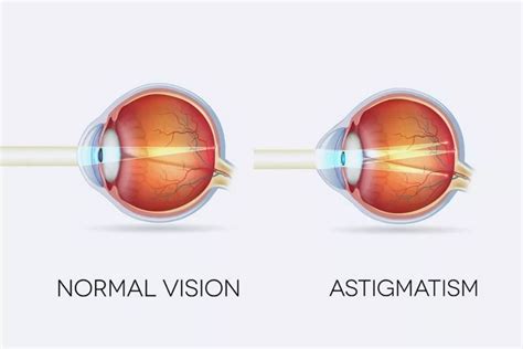 Is glare an astigmatism?