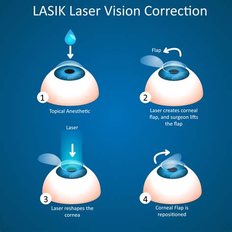 Is glare permanent after LASIK?
