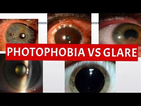Is glare same as photophobia?