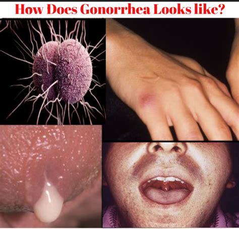 Is gonorrhea discharge white?