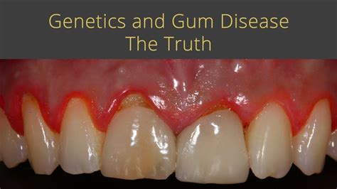 Is gum disease genetic?