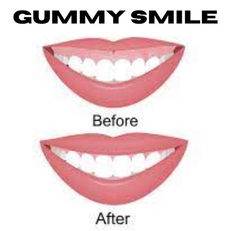 Is gummy smile attractive?