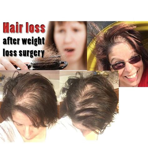 Is hair loss from weight loss permanent?