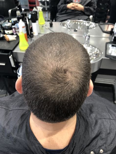 Is hair thinning temporary?