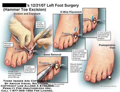 Is hammer toe permanent?