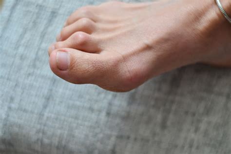 Is hammertoe a disability?