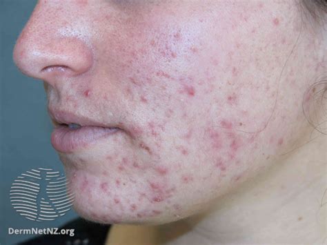 Is having acne at 15 normal?