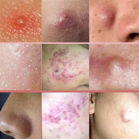 Is heat or ice better for cystic acne?