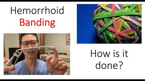 Is hemorrhoid banding worth it?