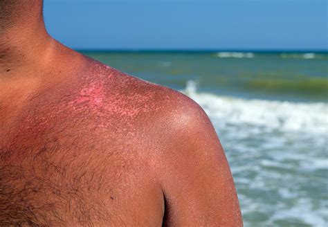 Is hot water bad for sunburn?
