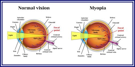 Is human eyesight getting worse?