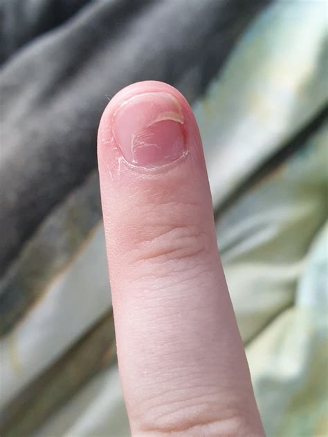 Is human nail scratch harmful?