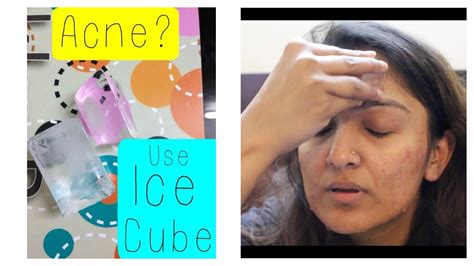 Is ice Cube good for cystic acne?