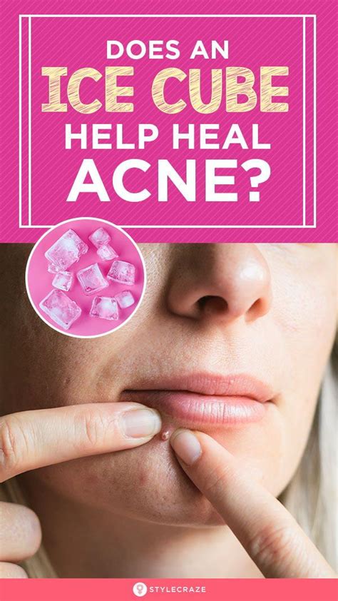 Is ice good for acne?