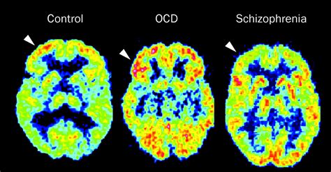 Is it OCD or schizophrenia?