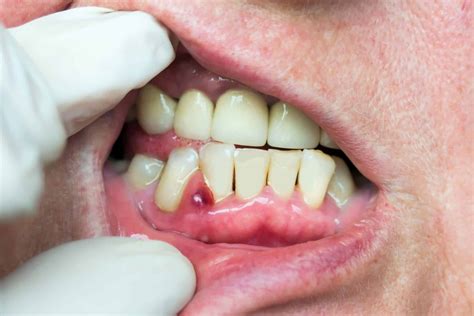 Is it OK if a gum abscess bursts?