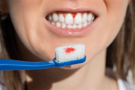 Is it OK to brush bleeding gums?