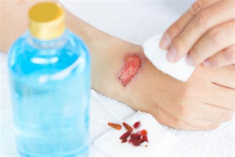 Is it OK to cover a burn wound?