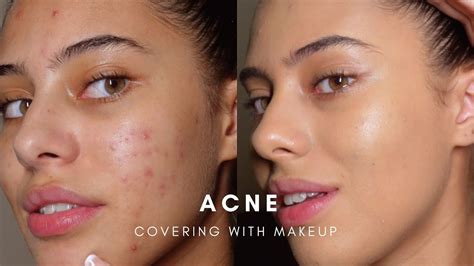 Is it OK to cover pimples with makeup?