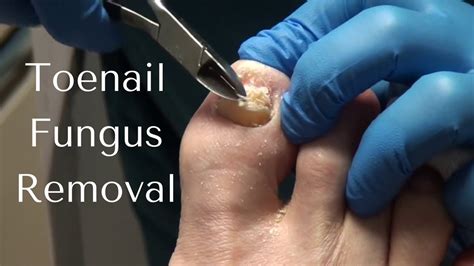 Is it OK to cut toenail fungus?