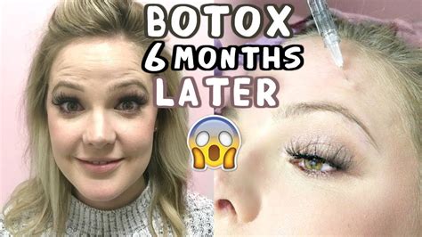 Is it OK to get Botox every 6 months?