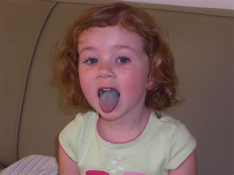 Is it OK to have a blue tongue?