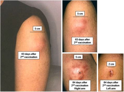 Is it OK to have a lump after an injection?