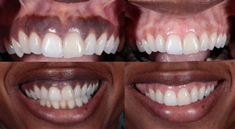 Is it OK to have brown gums?