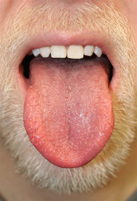 Is it OK to have bumps on your tongue?