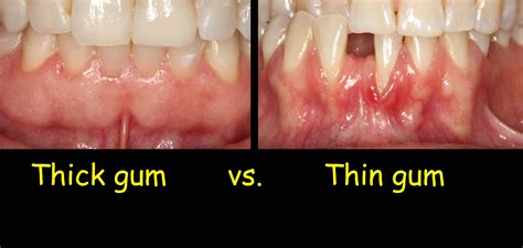 Is it OK to have thin gums?