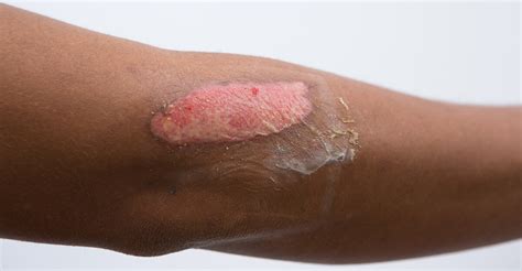 Is it OK to leave a burn uncovered?