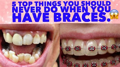 Is it OK to never get braces?