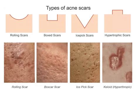 Is it OK to pick acne?