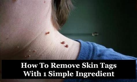 Is it OK to pinch off skin tags?