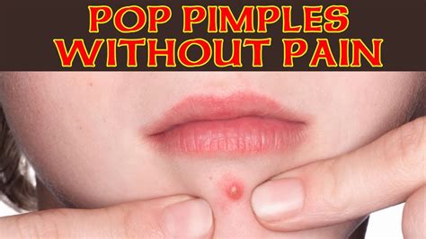 Is it OK to pop pimple on lip?