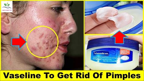 Is it OK to put Vaseline on a popped pimple?