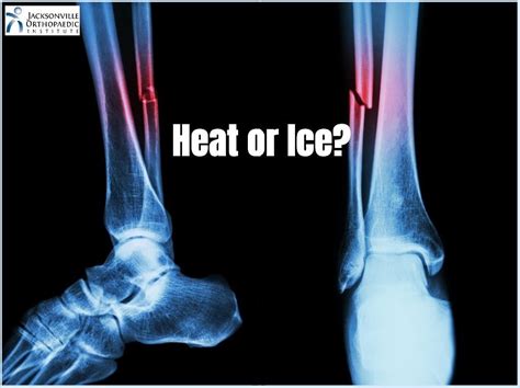 Is it OK to put ice on a broken bone?