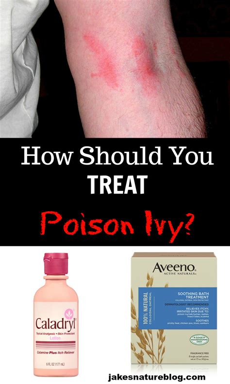 Is it OK to put lotion on poison ivy?
