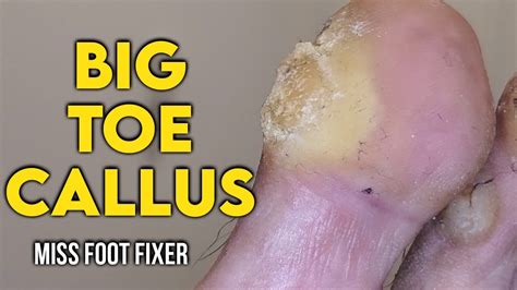 Is it OK to shave calluses?