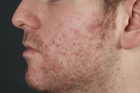 Is it OK to shave with folliculitis?