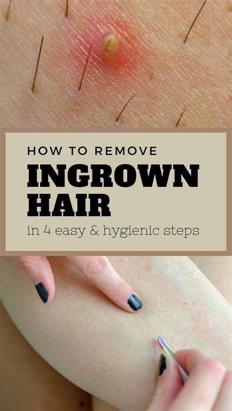 Is it OK to squeeze pus out of ingrown hair?