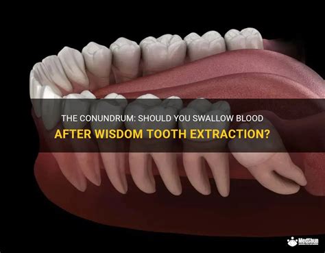 Is it OK to swallow blood after wisdom teeth?
